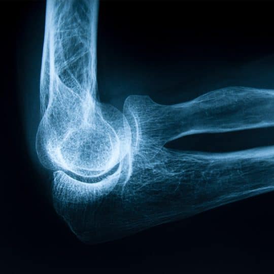Röntgenbild av ett ben