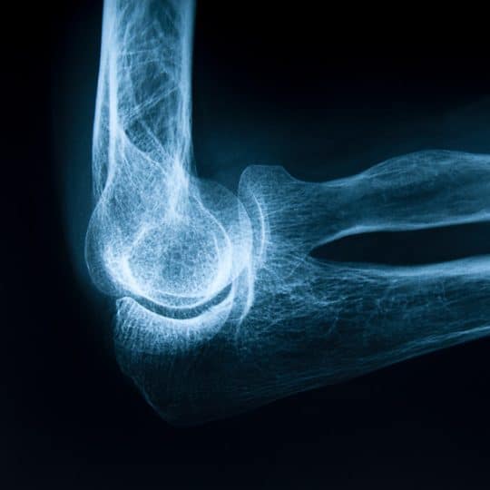 Röntgenbild av ett ben